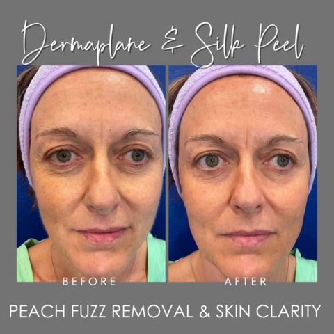 Before & After Peach Fuzz Removal and Skin Clarity