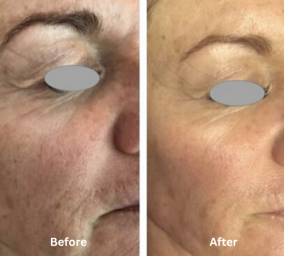 Before and after of Full Ablative Tixel Skin Resurfacing