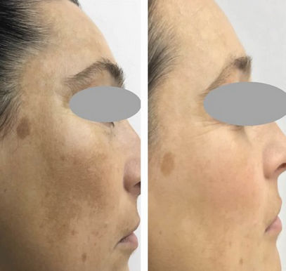 Before and After Open Channel Tixel Skin Resurfacing