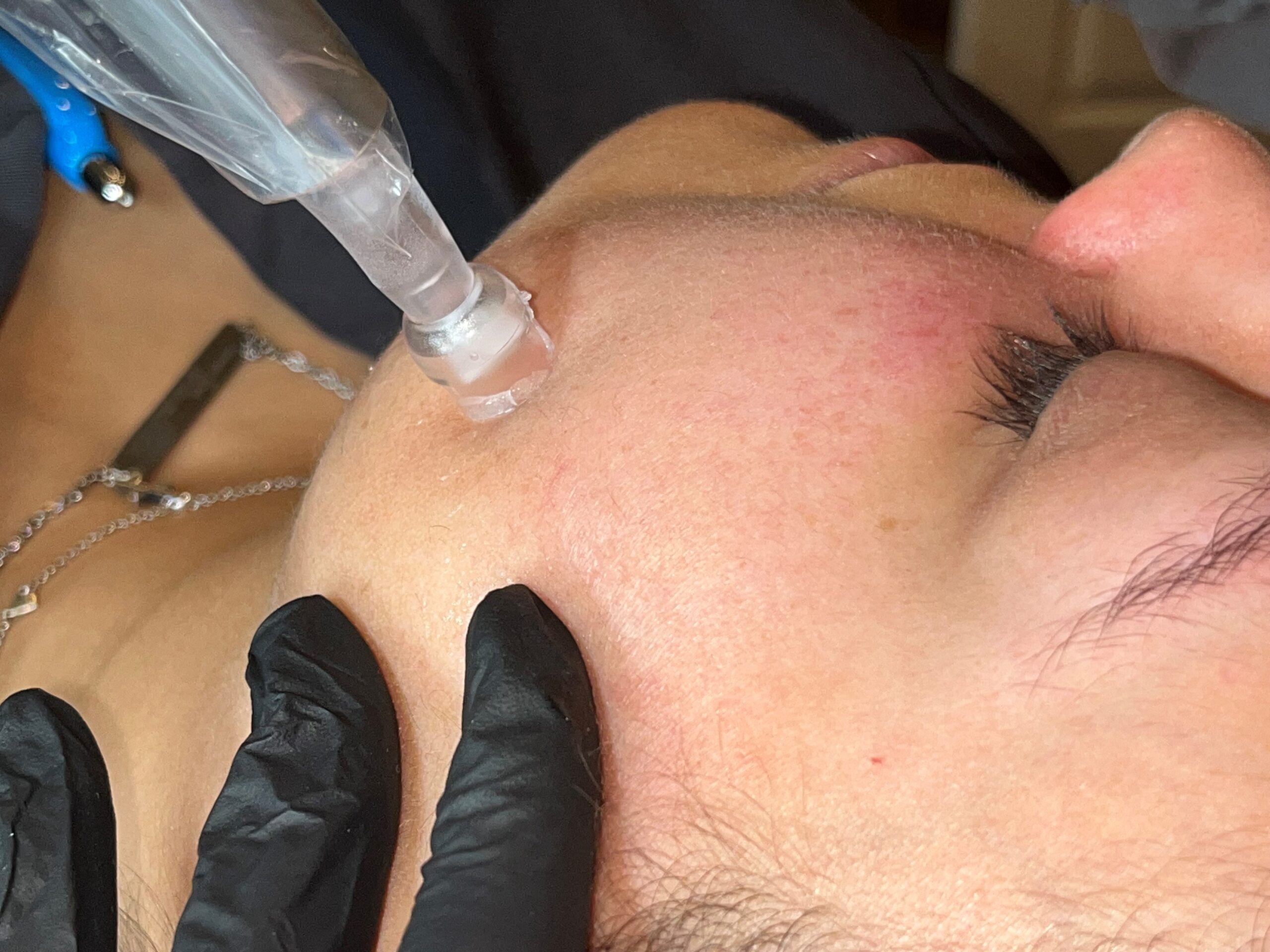 Microneedling in Visibly Beautiful