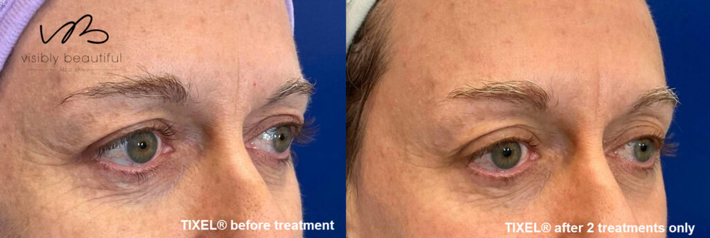 Customer before and after 2 tixel anti aging treatments